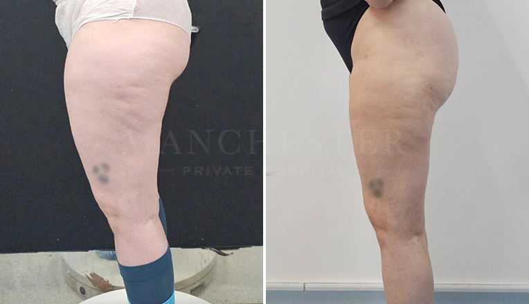 leg liposuction before and after