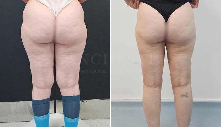 leg liposuction before and after