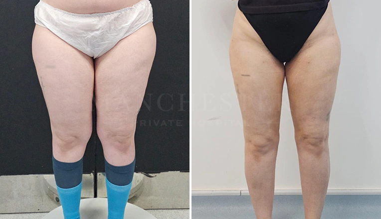 leg liposuction before and after