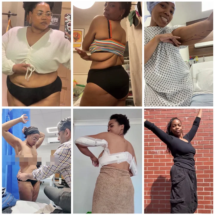 Shahira’s Loose Skin Removal Surgery Journey Collage