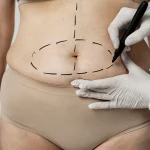 Tummy Tuck Belly Button: What Happens During Surgery?