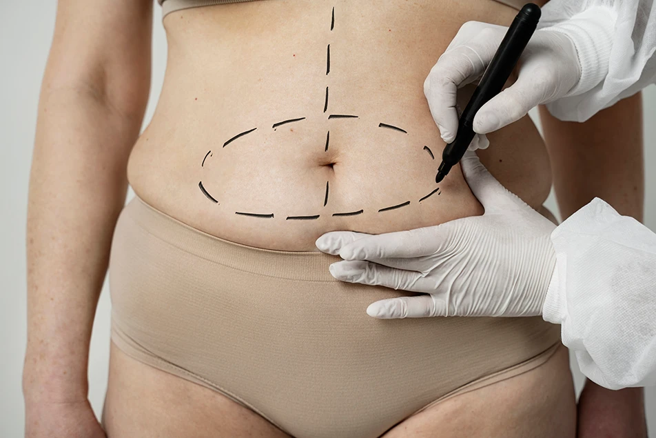 Surgeon marking the abdomen around the belly button before tummy tuck surgery