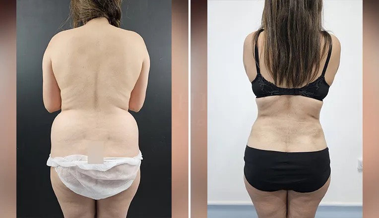 Liposuction on Abdomen & Back