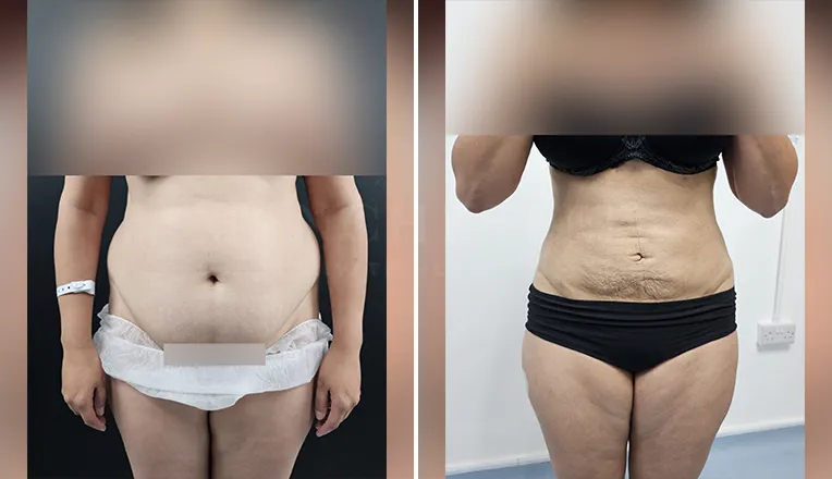 Liposuction on Abdomen & Back