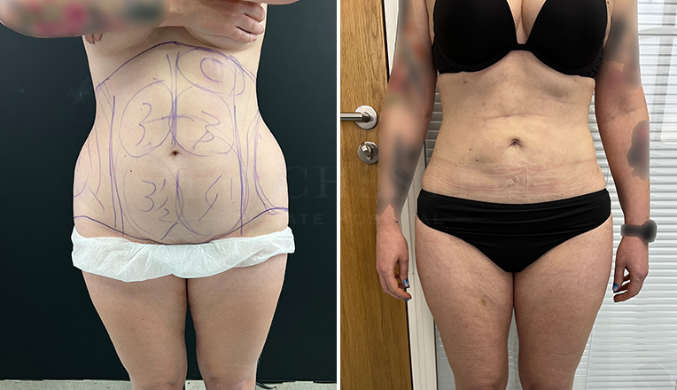 Liposuction on Abdomen & Back