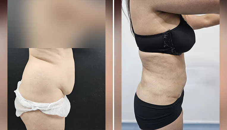 Liposuction on Abdomen & Back