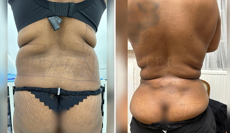 love handle lipo before and after