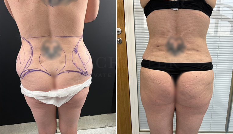 Liposuction on Abdomen & Back