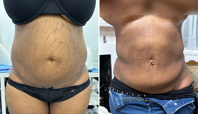 stomach vaser lipo before and after patient
