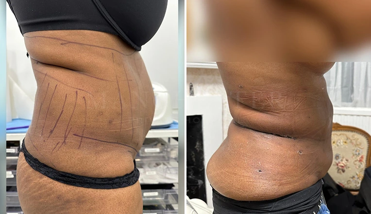 vaser liposuction abdomen and flanks before and after result