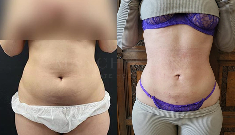 vaser liposuction patient